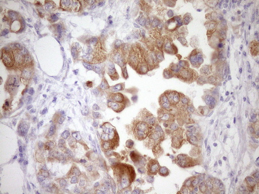 WIBG Antibody - Immunohistochemical staining of paraffin-embedded Adenocarcinoma of Human endometrium tissue using anti-WIBG mouse monoclonal antibody. (Heat-induced epitope retrieval by Tris-EDTA, pH8.0)(1:150)