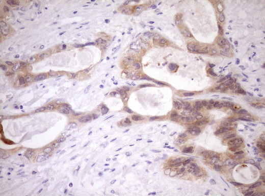 WIBG Antibody - Immunohistochemical staining of paraffin-embedded Adenocarcinoma of Human colon tissue using anti-WIBG mouse monoclonal antibody. (Heat-induced epitope retrieval by Tris-EDTA, pH8.0)(1:150)