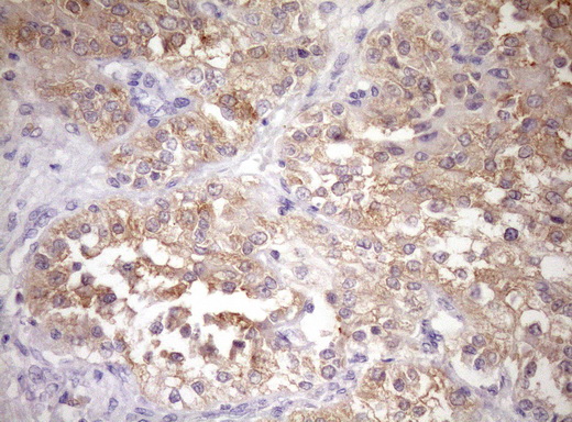 WIBG Antibody - Immunohistochemical staining of paraffin-embedded Carcinoma of Human kidney tissue using anti-WIBG mouse monoclonal antibody. (Heat-induced epitope retrieval by Tris-EDTA, pH8.0)(1:150)