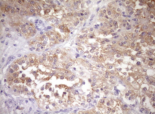 WIBG Antibody - IHC of paraffin-embedded Carcinoma of Human kidney tissue using anti-WIBG mouse monoclonal antibody. (Heat-induced epitope retrieval by Tris-EDTA, pH8.0)(1:150).
