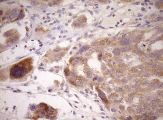 WIBG Antibody - IHC of paraffin-embedded Adenocarcinoma of Human ovary tissue using anti-WIBG mouse monoclonal antibody. (Heat-induced epitope retrieval by Tris-EDTA, pH8.0)(1:150).