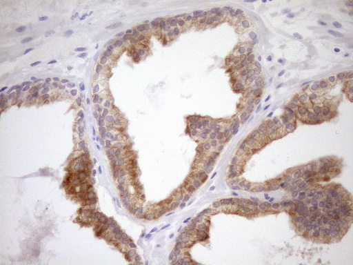 WIBG Antibody - IHC of paraffin-embedded Carcinoma of Human prostate tissue using anti-WIBG mouse monoclonal antibody. (Heat-induced epitope retrieval by Tris-EDTA, pH8.0)(1:150).