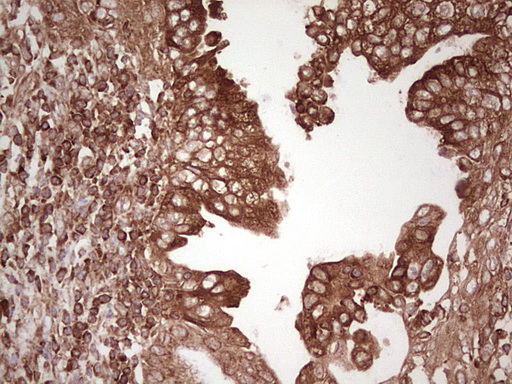 WIBG Antibody - Immunohistochemical staining of paraffin-embedded Carcinoma of Human pancreas tissue using anti-WIBG mouse monoclonal antibody. (Heat-induced epitope retrieval by 1 mM EDTA in 10mM Tris, pH8.5, 120C for 3min,