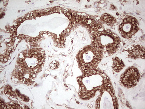 WIBG Antibody - IHC of paraffin-embedded Adenocarcinoma of Human breast tissue using anti-WIBG mouse monoclonal antibody. (Heat-induced epitope retrieval by 1 mM EDTA in 10mM Tris, pH8.5, 120°C for 3min).