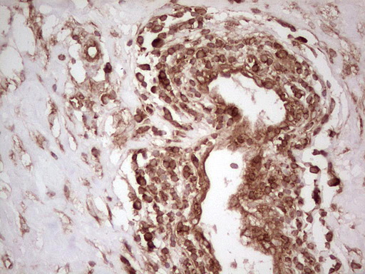 WIBG Antibody - Immunohistochemical staining of paraffin-embedded Carcinoma of Human lung tissue using anti-WIBG mouse monoclonal antibody. (Heat-induced epitope retrieval by 1 mM EDTA in 10mM Tris, pH8.5, 120C for 3min,