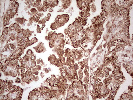 WIBG Antibody - Immunohistochemical staining of paraffin-embedded Adenocarcinoma of Human ovary tissue using anti-WIBG mouse monoclonal antibody. (Heat-induced epitope retrieval by 1 mM EDTA in 10mM Tris, pH8.5, 120C for 3min,