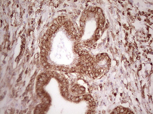 WIBG Antibody - Immunohistochemical staining of paraffin-embedded Carcinoma of Human pancreas tissue using anti-WIBG mouse monoclonal antibody. (Heat-induced epitope retrieval by 1 mM EDTA in 10mM Tris, pH8.5, 120C for 3min,