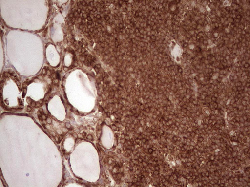 WIBG Antibody - Immunohistochemical staining of paraffin-embedded Human thyroid tissue within the normal limits using anti-WIBG mouse monoclonal antibody. (Heat-induced epitope retrieval by 1 mM EDTA in 10mM Tris, pH8.5, 120C for 3min,