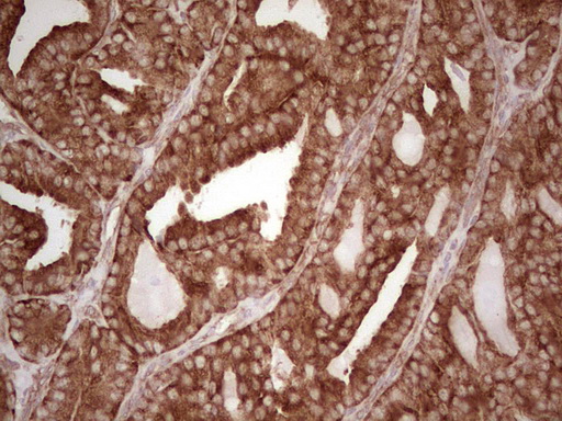 WIBG Antibody - Immunohistochemical staining of paraffin-embedded Carcinoma of Human thyroid tissue using anti-WIBG mouse monoclonal antibody. (Heat-induced epitope retrieval by 1 mM EDTA in 10mM Tris, pH8.5, 120C for 3min,