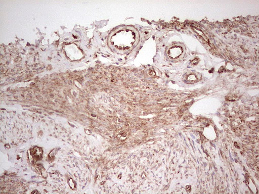 WIBG Antibody - Immunohistochemical staining of paraffin-embedded Adenocarcinoma of Human endometrium tissue using anti-WIBG mouse monoclonal antibody. (Heat-induced epitope retrieval by 1 mM EDTA in 10mM Tris, pH8.5, 120C for 3min,