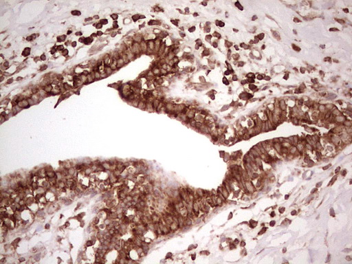 WIBG Antibody - Immunohistochemical staining of paraffin-embedded Adenocarcinoma of Human breast tissue using anti-WIBG mouse monoclonal antibody. (Heat-induced epitope retrieval by 1 mM EDTA in 10mM Tris, pH8.5, 120C for 3min,
