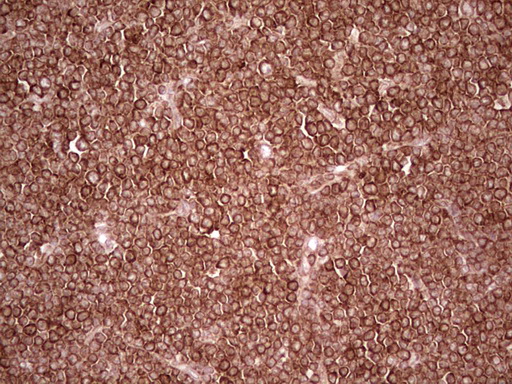 WIBG Antibody - Immunohistochemical staining of paraffin-embedded Human lymphoma tissue using anti-WIBG mouse monoclonal antibody. (Heat-induced epitope retrieval by 1 mM EDTA in 10mM Tris, pH8.5, 120C for 3min,