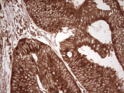 WIBG Antibody - Immunohistochemical staining of paraffin-embedded Adenocarcinoma of Human colon tissue using anti-WIBG mouse monoclonal antibody. (Heat-induced epitope retrieval by 1 mM EDTA in 10mM Tris, pH8.5, 120C for 3min,