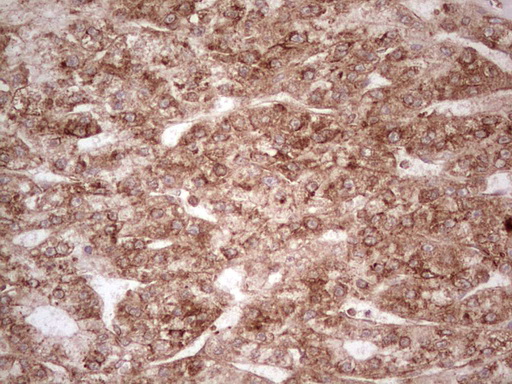 WIBG Antibody - Immunohistochemical staining of paraffin-embedded Carcinoma of Human liver tissue using anti-WIBG mouse monoclonal antibody. (Heat-induced epitope retrieval by 1 mM EDTA in 10mM Tris, pH8.5, 120C for 3min,