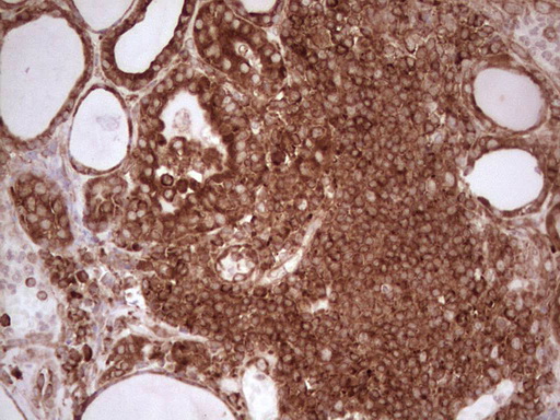 WIBG Antibody - Immunohistochemical staining of paraffin-embedded Human thyroid tissue within the normal limits using anti-WIBG mouse monoclonal antibody. (Heat-induced epitope retrieval by 1 mM EDTA in 10mM Tris, pH8.5, 120C for 3min,