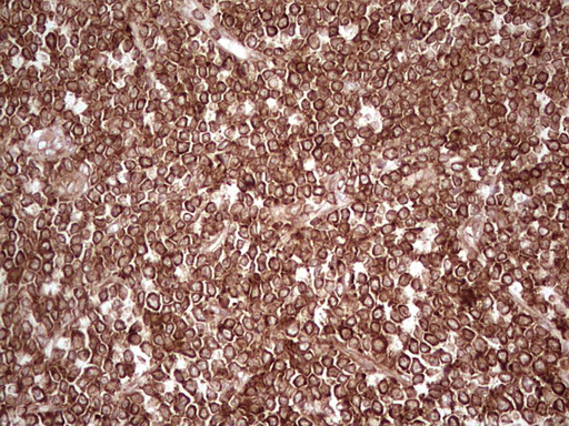 WIBG Antibody - Immunohistochemical staining of paraffin-embedded Human lymphoma tissue using anti-WIBG mouse monoclonal antibody. (Heat-induced epitope retrieval by 1 mM EDTA in 10mM Tris, pH8.5, 120C for 3min,