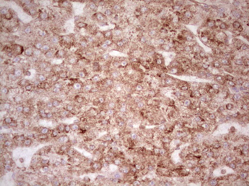 WIBG Antibody - Immunohistochemical staining of paraffin-embedded Carcinoma of Human liver tissue using anti-WIBG mouse monoclonal antibody. (Heat-induced epitope retrieval by 1 mM EDTA in 10mM Tris, pH8.5, 120C for 3min,