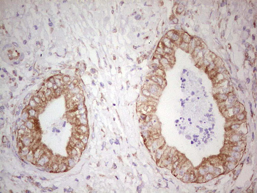 WIBG Antibody - IHC of paraffin-embedded Carcinoma of Human pancreas tissue using anti-WIBG mouse monoclonal antibody. (Heat-induced epitope retrieval by 1 mM EDTA in 10mM Tris, pH8.5, 120°C for 3min).