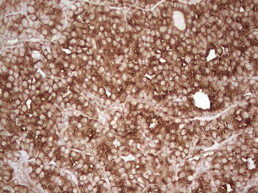 WIBG Antibody - IHC of paraffin-embedded Carcinoma of Human thyroid tissue using anti-WIBG mouse monoclonal antibody. (Heat-induced epitope retrieval by 1 mM EDTA in 10mM Tris, pH8.5, 120°C for 3min).