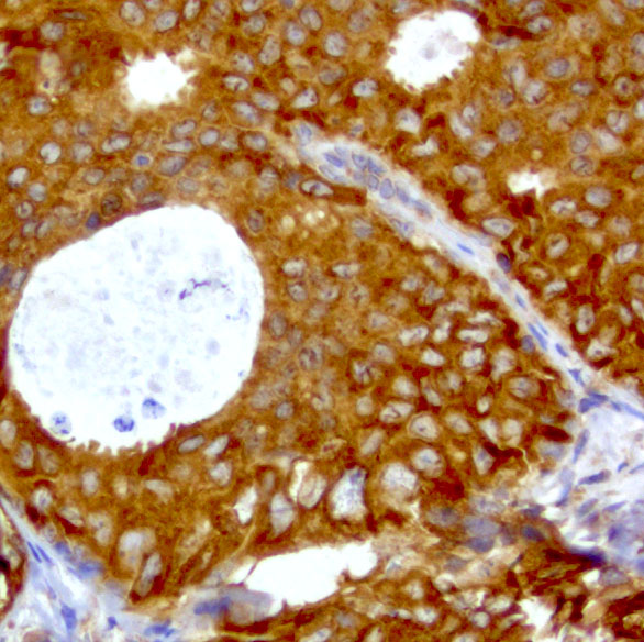 WIBG Antibody - Immunohistochemical staining of paraffin-embedded breast carcinoma with mouse anti-WIBG clone UMAB207 1:400 of 1mg/mL using HIER TEE pH9.0 [GBI Labs B21-Tris/EDTA HIER]. Expression of WIBG is cytoplasmic.