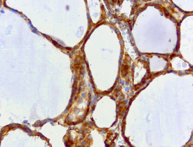 WIBG Antibody - Immunohistochemical staining of paraffin-embedded thyroid with mouse anti-WIBG clone UMAB207 1:400 of 1mg/mL using HIER TEE pH9.0 [GBI Labs B21-Tris/EDTA HIER]. Expression of WIBG is cytoplasmic.