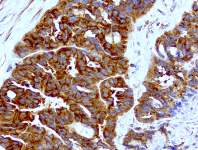 WIBG Antibody - Immunohistochemical staining of paraffin-embedded ovarian cancer with mouse anti-WIBG clone UMAB207 1:400 of 1mg/mL using HIER TEE pH9.0 [GBI Labs B21-Tris/EDTA HIER]. Expression of WIBG is cytoplasmic.