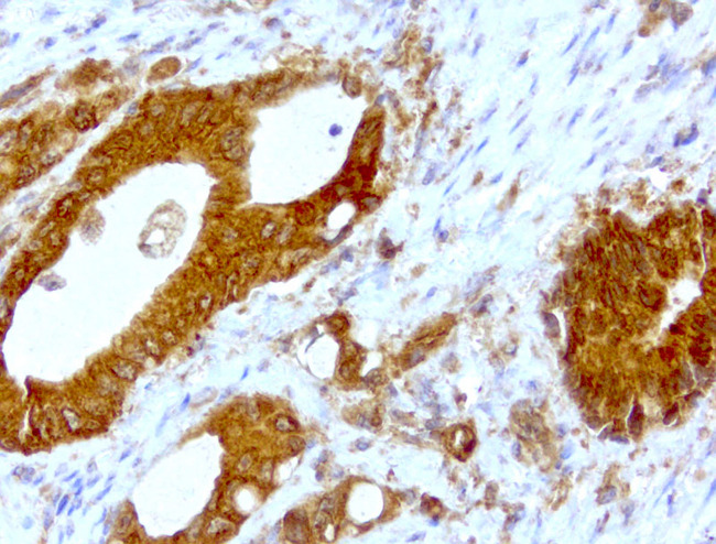 WIBG Antibody - Immunohistochemical staining of paraffin-embedded colon cancer with mouse anti-WIBG clone UMAB207 1:400 of 1mg/mL using HIER TEE pH9.0 [GBI Labs B21-Tris/EDTA HIER]. Expression of WIBG is cytoplasmic.