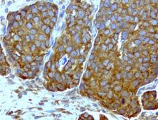 WIBG Antibody - Immunohistochemical staining of paraffin-embedded ovarian cancer with mouse anti-WIBG clone UMAB208 1:400 of 1mg/mL using HIER TEE pH9.0 [GBI Labs B21-Tris/EDTA HIER]. Expression of WIBG is cytoplasmic.