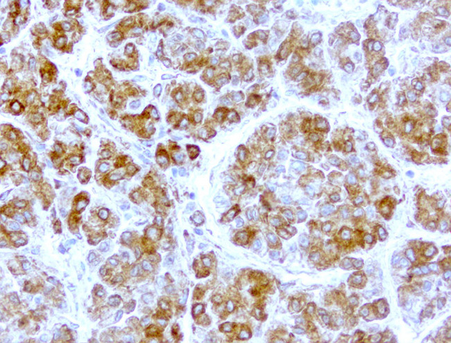 WIBG Antibody - Immunohistochemical staining of paraffin-embedded liver cancer with mouse anti-WIBG clone UMAB208 1:400 of 1mg/mL using HIER TEE pH9.0 [GBI Labs B21-Tris/EDTA HIER]. Expression of WIBG is cytoplasmic.