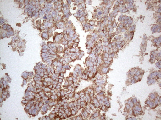 WIBG Antibody - Immunohistochemical staining of paraffin-embedded Adenocarcinoma of Human ovary tissue using anti-WIBG mouse monoclonal antibody. (Heat-induced epitope retrieval by 1mM EDTA in 10mM Tris buffer. (pH8.5) at 110C for 10 min. (1:500)