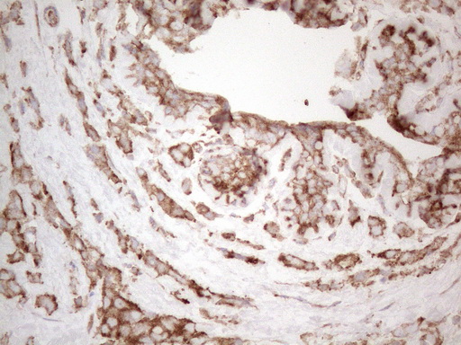 WIBG Antibody - Immunohistochemical staining of paraffin-embedded Adenocarcinoma of Human breast tissue using anti-WIBG mouse monoclonal antibody. (Heat-induced epitope retrieval by 1mM EDTA in 10mM Tris buffer. (pH8.5) at 110C for 10 min. (1:500)