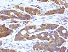 WIBG Antibody - Immunohistochemical staining of paraffin-embedded ovarian cancer with mouse anti-WIBG clone UMAB209 1:400 of 1mg/mL using HIER TEE pH9.0 [GBI Labs B21-Tris/EDTA HIER]. Expression of WIBG is cytoplasmic.