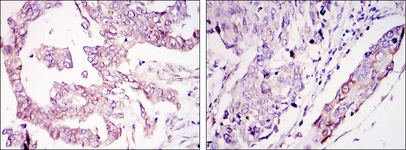 WIF1 Antibody - IHC of paraffin-embedded ovary tumor tissues (left) and lung cancer (right) using WIF1 mouse monoclonal antibody with DAB staining.