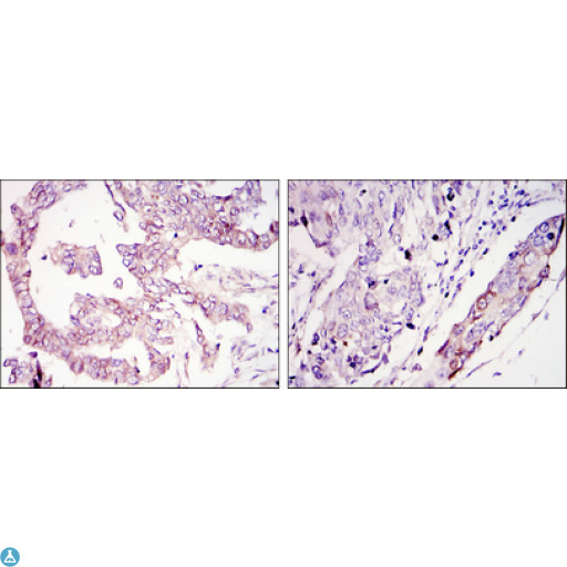 WIF1 Antibody - Immunohistochemistry (IHC) analysis of paraffin-embedded ovary tumour tissues (left) and lung cancer (right) with DAB staining using WIF-1 Monoclonal Antibody.