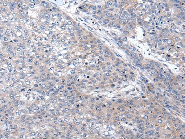 WIF1 Antibody - Immunohistochemistry of paraffin-embedded Human liver cancer tissue  using WIF1 Polyclonal Antibody at dilution of 1:100(×200)