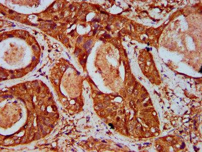 WIPF2 / WIRE Antibody - Immunohistochemistry Dilution at 1:500 and staining in paraffin-embedded human cervical cancer performed on a Leica BondTM system. After dewaxing and hydration, antigen retrieval was mediated by high pressure in a citrate buffer (pH 6.0). Section was blocked with 10% normal Goat serum 30min at RT. Then primary antibody (1% BSA) was incubated at 4°C overnight. The primary is detected by a biotinylated Secondary antibody and visualized using an HRP conjugated SP system.