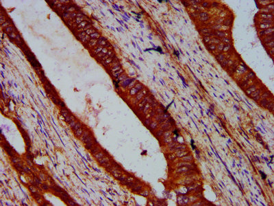 WIPF2 / WIRE Antibody - Immunohistochemistry Dilution at 1:500 and staining in paraffin-embedded human colon cancer performed on a Leica BondTM system. After dewaxing and hydration, antigen retrieval was mediated by high pressure in a citrate buffer (pH 6.0). Section was blocked with 10% normal Goat serum 30min at RT. Then primary antibody (1% BSA) was incubated at 4°C overnight. The primary is detected by a biotinylated Secondary antibody and visualized using an HRP conjugated SP system.