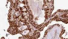 WIPI2 Antibody - 1:100 staining human thyroid carcinoma tissue by IHC-P. The sample was formaldehyde fixed and a heat mediated antigen retrieval step in citrate buffer was performed. The sample was then blocked and incubated with the antibody for 1.5 hours at 22°C. An HRP conjugated goat anti-rabbit antibody was used as the secondary.