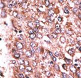 WISP3 Antibody - Formalin-fixed and paraffin-embedded human cancer tissue reacted with the primary antibody, which was peroxidase-conjugated to the secondary antibody, followed by DAB staining. This data demonstrates the use of this antibody for immunohistochemistry; clinical relevance has not been evaluated. BC = breast carcinoma; HC = hepatocarcinoma.