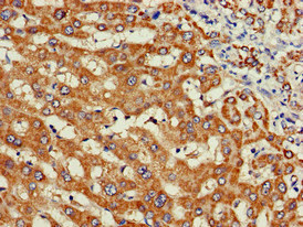 WISP3 Antibody - Immunohistochemistry of paraffin-embedded human liver cancer at dilution of 1:100