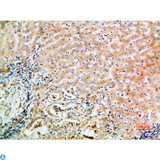 WISP3 Antibody - Immunohistochemical analysis of paraffin-embedded human-liver-cancer, antibody was diluted at 1:200.