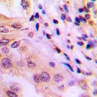 WNK1 Antibody - Immunohistochemical analysis of p65 (pT60) staining in human lung cancer formalin fixed paraffin embedded tissue section. The section was pre-treated using heat mediated antigen retrieval with sodium citrate buffer (pH 6.0). The section was then incubated with the antibody at room temperature and detected using an HRP-conjugated compact polymer system. DAB was used as the chromogen. The section was then counterstained with hematoxylin and mounted with DPX.