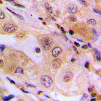 WNK1 Antibody - Immunohistochemical analysis of p65 staining in human lung cancer formalin fixed paraffin embedded tissue section. The section was pre-treated using heat mediated antigen retrieval with sodium citrate buffer (pH 6.0). The section was then incubated with the antibody at room temperature and detected using an HRP-conjugated compact polymer system. DAB was used as the chromogen. The section was then counterstained with hematoxylin and mounted with DPX.