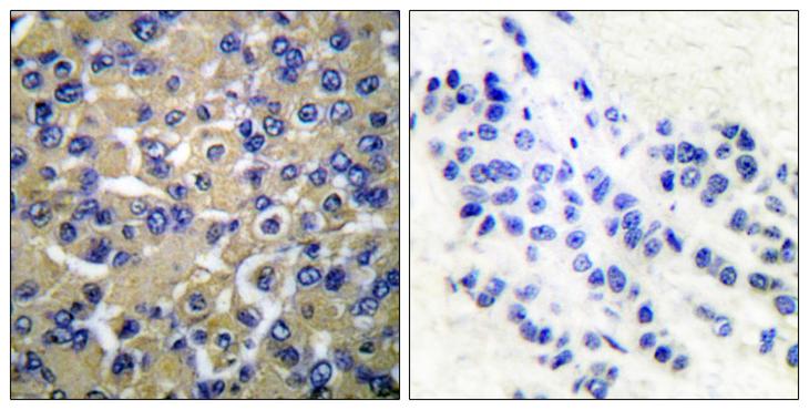 WNK1 Antibody - Peptide - + Immunohistochemical analysis of paraffin-embedded human breast carcinoma tissue using WNK1 (Ab-58) antibody.