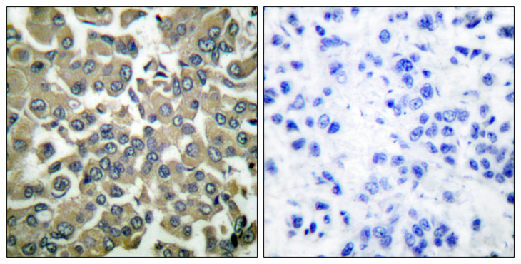 WNK1 Antibody - Immunohistochemistry analysis of paraffin-embedded human breast carcinoma, using WNK1 (Phospho-Thr58) Antibody. The picture on the right is blocked with the phospho peptide.
