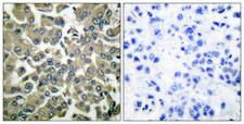 WNK1 Antibody - Immunohistochemistry analysis of paraffin-embedded human breast carcinoma, using WNK1 (Phospho-Thr58) Antibody. The picture on the right is blocked with the phospho peptide.