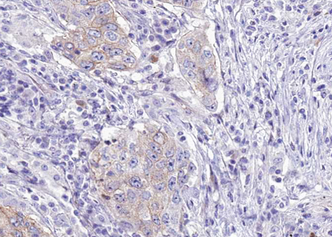WNK1 Antibody - 1:100 staining human lung carcinoma tissue by IHC-P. The tissue was formaldehyde fixed and a heat mediated antigen retrieval step in citrate buffer was performed. The tissue was then blocked and incubated with the antibody for 1.5 hours at 22°C. An HRP conjugated goat anti-rabbit antibody was used as the secondary.