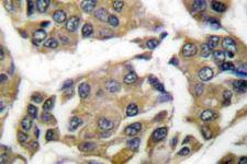 WNK1 Antibody - Immunohistochemistry (IHC) analysis of p-WNK1 (T60) pAb in paraffin-embedded human breast cancer tissue.