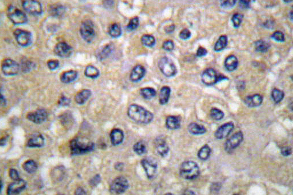 WNK1 Antibody - IHC of WNK1 (Y52) pAb in paraffin-embedded human breast carcinoma tissue.