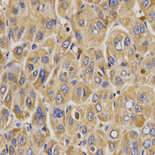 WNK3 / PRKWNK3 Antibody - Immunohistochemistry of paraffin-embedded human liver cancer tissue.